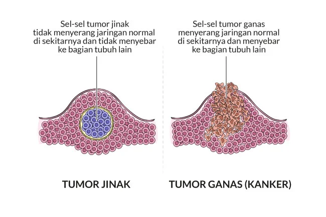 obat tumor ganas dan jinak ampuh - obat kanker payudara - obat tumor otak - obat herbal untuk tumor - obat tumor hati - obat alami tumor - obat herbal tumor payudara (1)