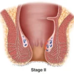 obat ambeien paling ampuh - obat ambeien stadium 2 - obat ambeien wasir - obat penyakit ambeien - cara mengobati ambeien - obat ambeien berdarah - obat pengempes benjolan ambeien