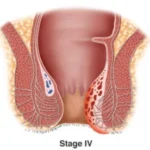 obat ambeien paling ampuh - obat ambeien stadium 4 - obat ambeien wasir - obat penyakit ambeien - cara mengobati ambeien - obat ambeien berdarah - obat pengempes benjolan ambeien