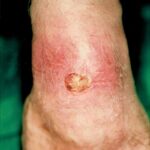 cara mengobati sipilis - cara mengatasi sipilis - cara menyembuhkan sipilis - cara menghilangkan luka sipilis tanpa bekas - cara mengobati sipilis pada pria dan wanita