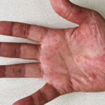 cara mengobati sipilis - cara mengatasi sipilis - cara menyembuhkan sipilis - cara menghilangkan luka sipilis tanpa bekas - cara mengobati sipilis pada pria dan wanita