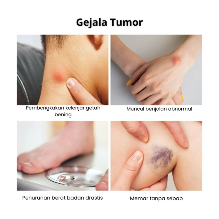 gejala dan pengobatan tumor - obat tumor jinak - obat tumor ganas - obat tumor paling ampuh - obat kanker - obat alami tumor - pengobatan tumor tanpa efek samping