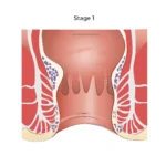 cara mengobati ambeien - cara mengatasi ambeien - cara menyembuhkan ambeien - cara mengobati ambeien pada ibu hamil - cara mengobati ambeien stadium 1 2 3 4 - cara mengemepeskan benjolan ambeien - cara menghilangkan benjolan ambeien - cara mengempeskan ambeien stadium 4 tanpa operasi - cara ampuh mengobati ambeien tanpa operasi - obat ambeien paling ampuh - obat ambeien untuk ibu hamil - obat ambeien stadium 1 2 3 4 - obat ambeien herbal alami - obat ambeien tanpa operasi