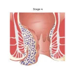 cara mengobati ambeien - cara mengatasi ambeien - cara menyembuhkan ambeien - cara mengobati ambeien pada ibu hamil - cara mengobati ambeien stadium 1 2 3 4 - cara mengemepeskan benjolan ambeien - cara menghilangkan benjolan ambeien - cara mengempeskan ambeien stadium 4 tanpa operasi - cara ampuh mengobati ambeien tanpa operasi - obat ambeien paling ampuh - obat ambeien untuk ibu hamil - obat ambeien stadium 1 2 3 4 - obat ambeien herbal alami - obat ambeien tanpa operasi