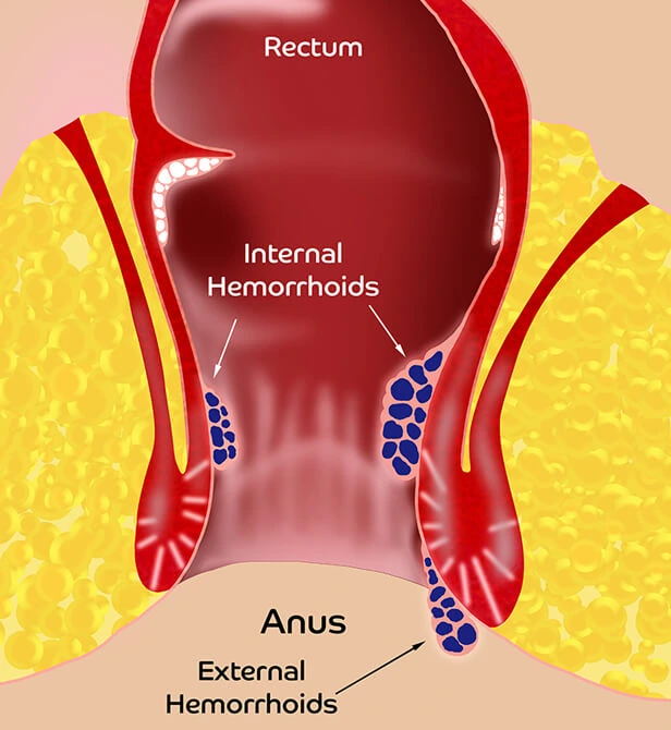 obat ambeien paling ampuh - obat pengempes ambeien luar - obat ambeien luar - obar ambeien dalam - obat ambeien aman untuk bumil - obat ambeien herbal alami - obat herbal untuk ambeien - penyakit ambeien - obat ambeien stadium 3 4 - cara mengobati amebien - obat menghilangkan benjolan ambeien tanpa operasi