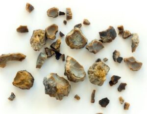 obat batu ginjal obat penghancur batu ginjal obat kencing batu obat batu ginjal ampuh obat peluruh batu ginjal